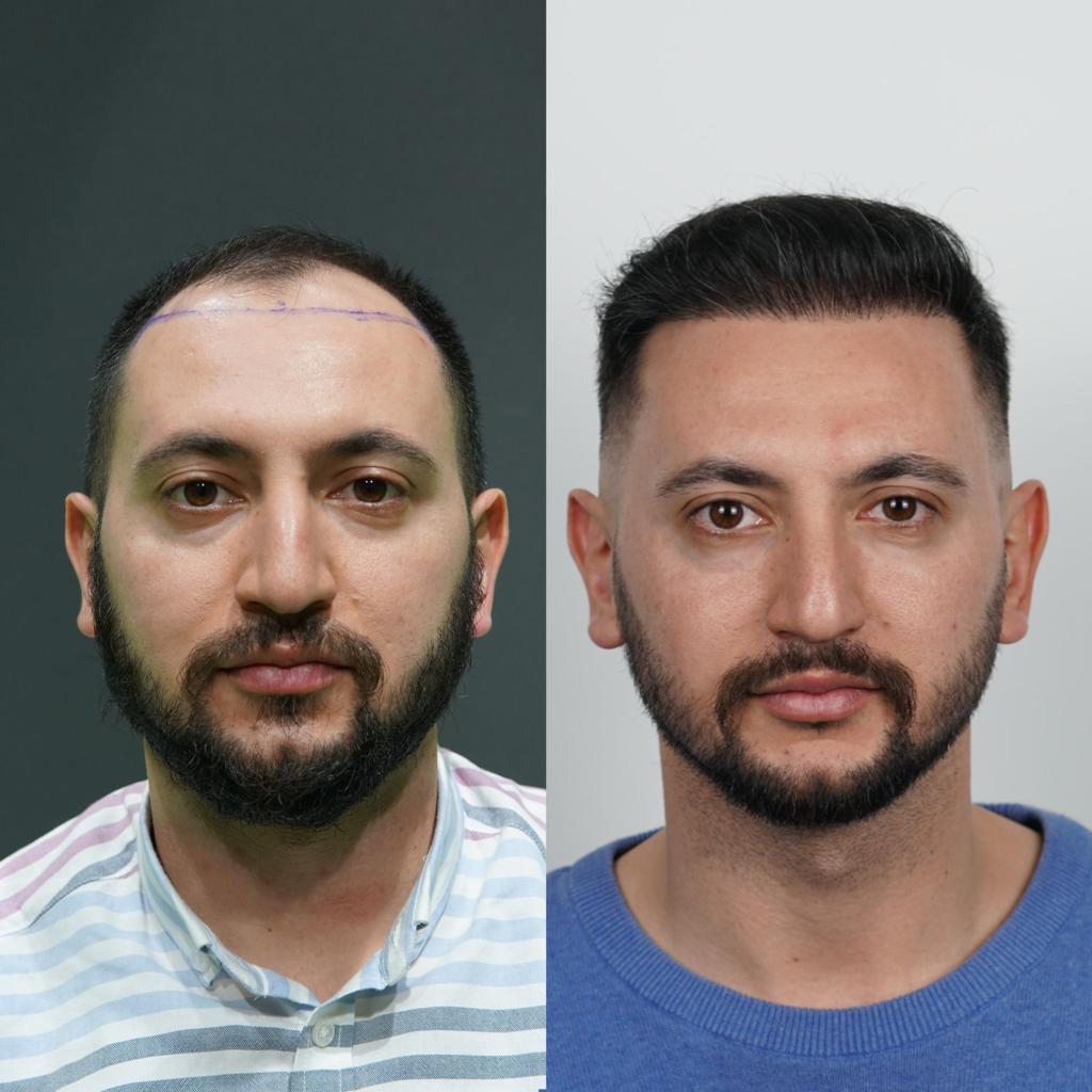 prima e dopo trapianto capelli 21